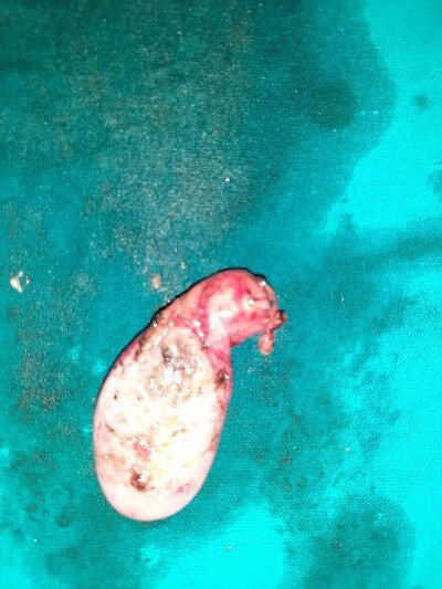 12 Gall Bladder