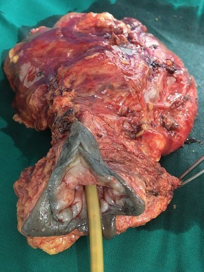 12 Total pelvic exenteration for advanced cervical cancer