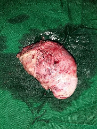 2 Left Ovarian Mass