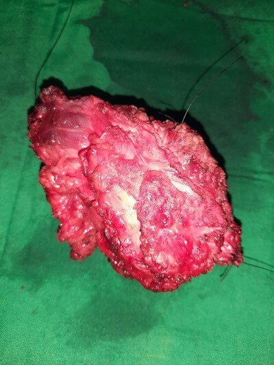 2 pevic tumour