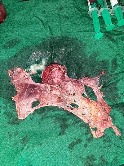 3 Uterus with Pelvic Peritoneum