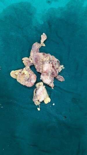 7c para aortic lymph node dissection