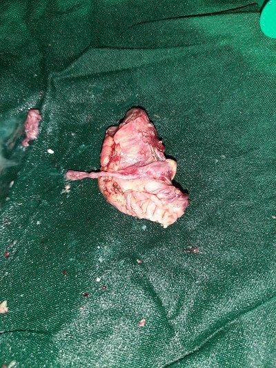 8 Resected Small bowel