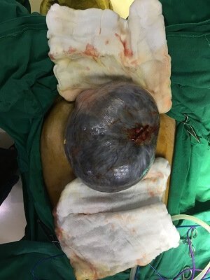 b Ovarian tumour