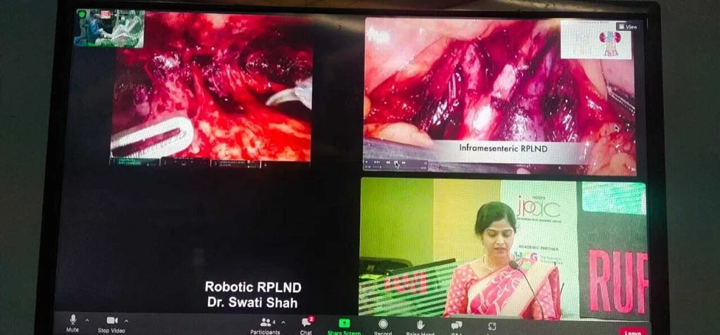 Master Video - Robotic Retroperitoneal Lymph Node Dissection in Supine position for Testicular Cancer