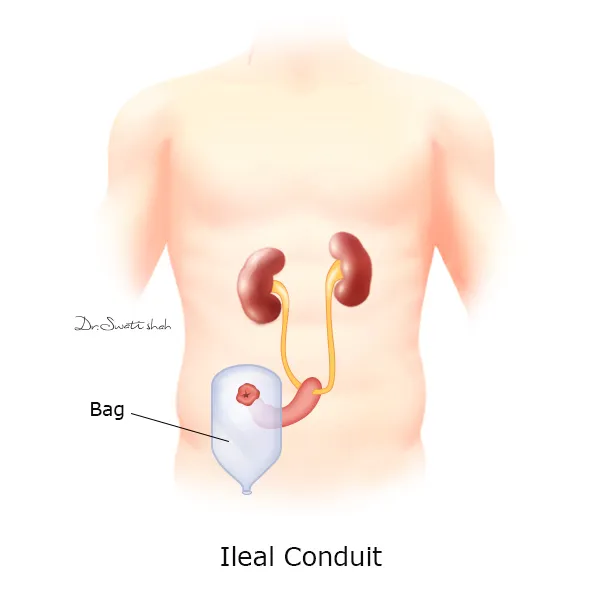 Ileal Conduit