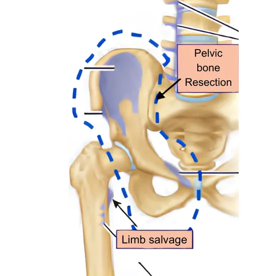 Internal Hemipelvectomy