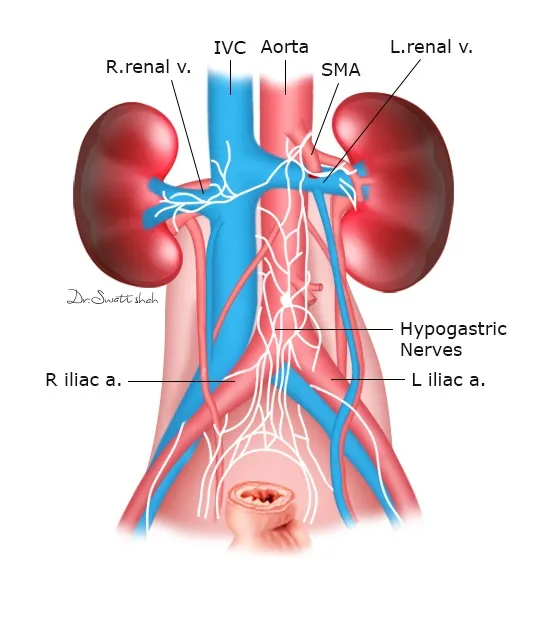 Nerve Preserving RPLND