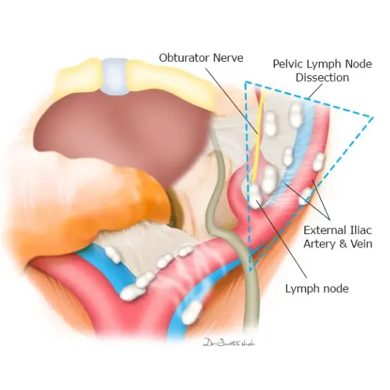 Pelvic Lymph Node Dissection 1