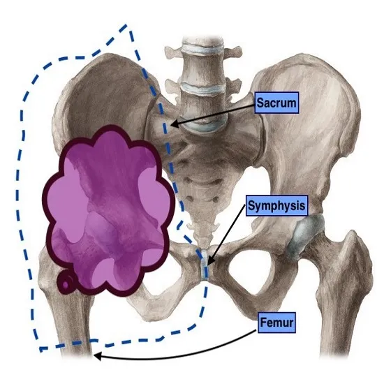 Pelvic bone tumour B tumour resection