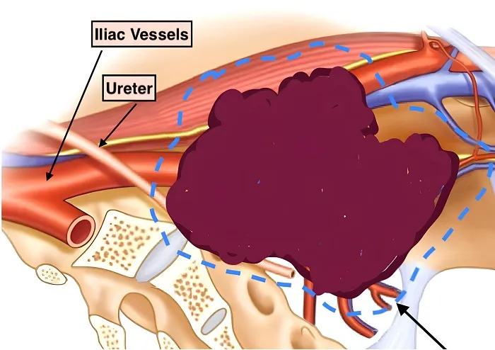 Recurrent sarcoma involving Iliac vessels ureter 1