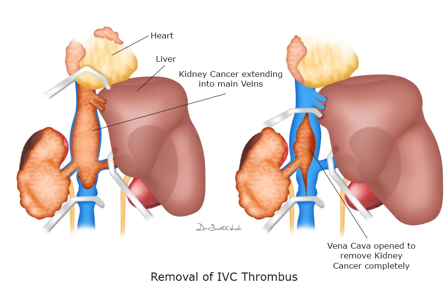 Renal Cancer with IVC thrombus