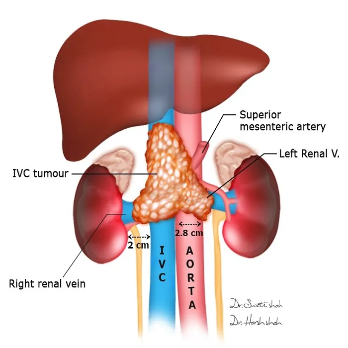 Retroperitoneal Cancers Their Resections