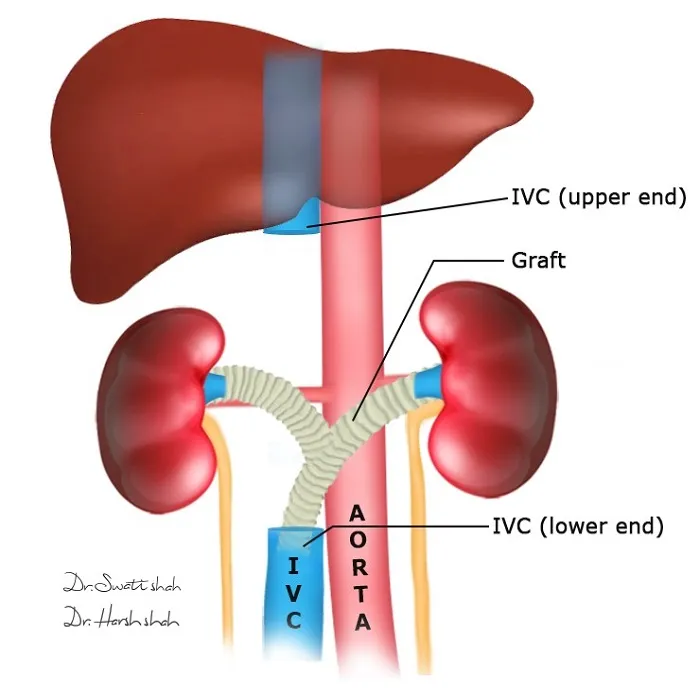 Retroperitoneal Cancers and Their Resections 1