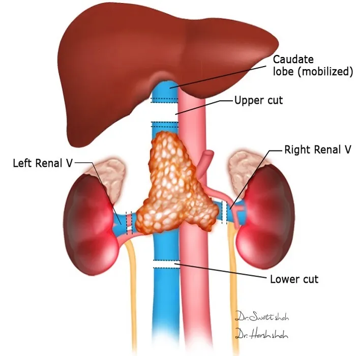 Retroperitoneal Cancers and Their Resections