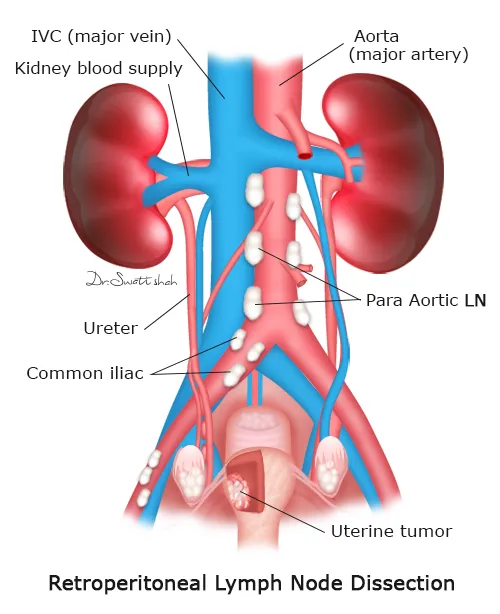 Retroperitoneal LND