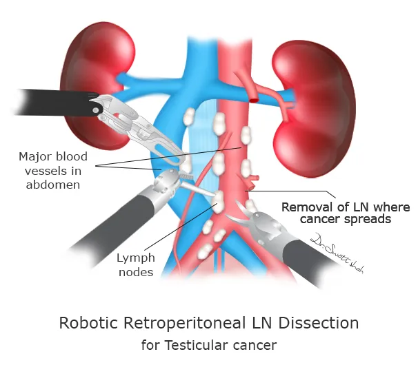 Robotic Retroperitoneal LN Dissection2