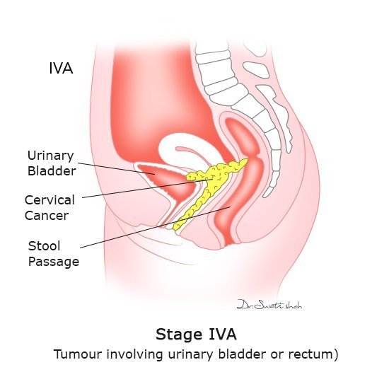 Stage IVA Tumor involving urinary bladder or rectum