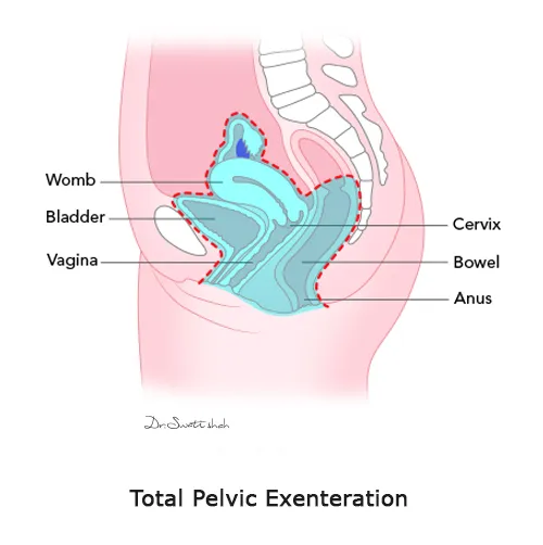 Total Pelvic