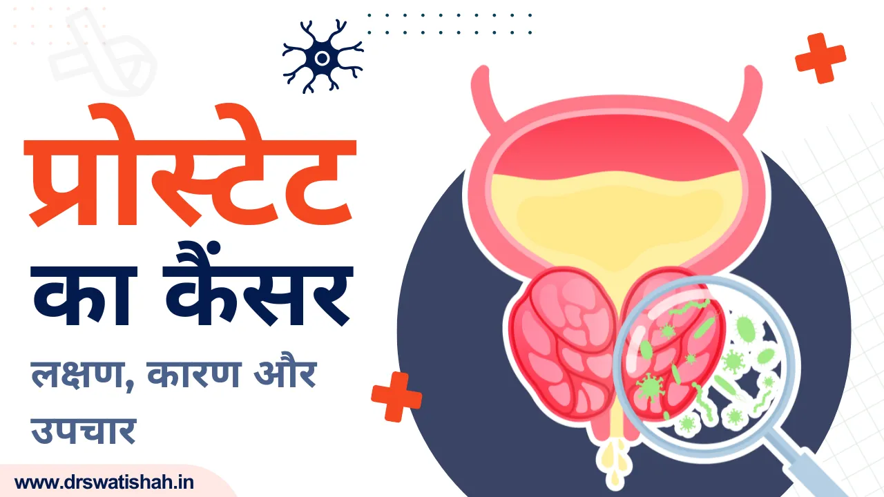 प्रोस्टेट कैंसर