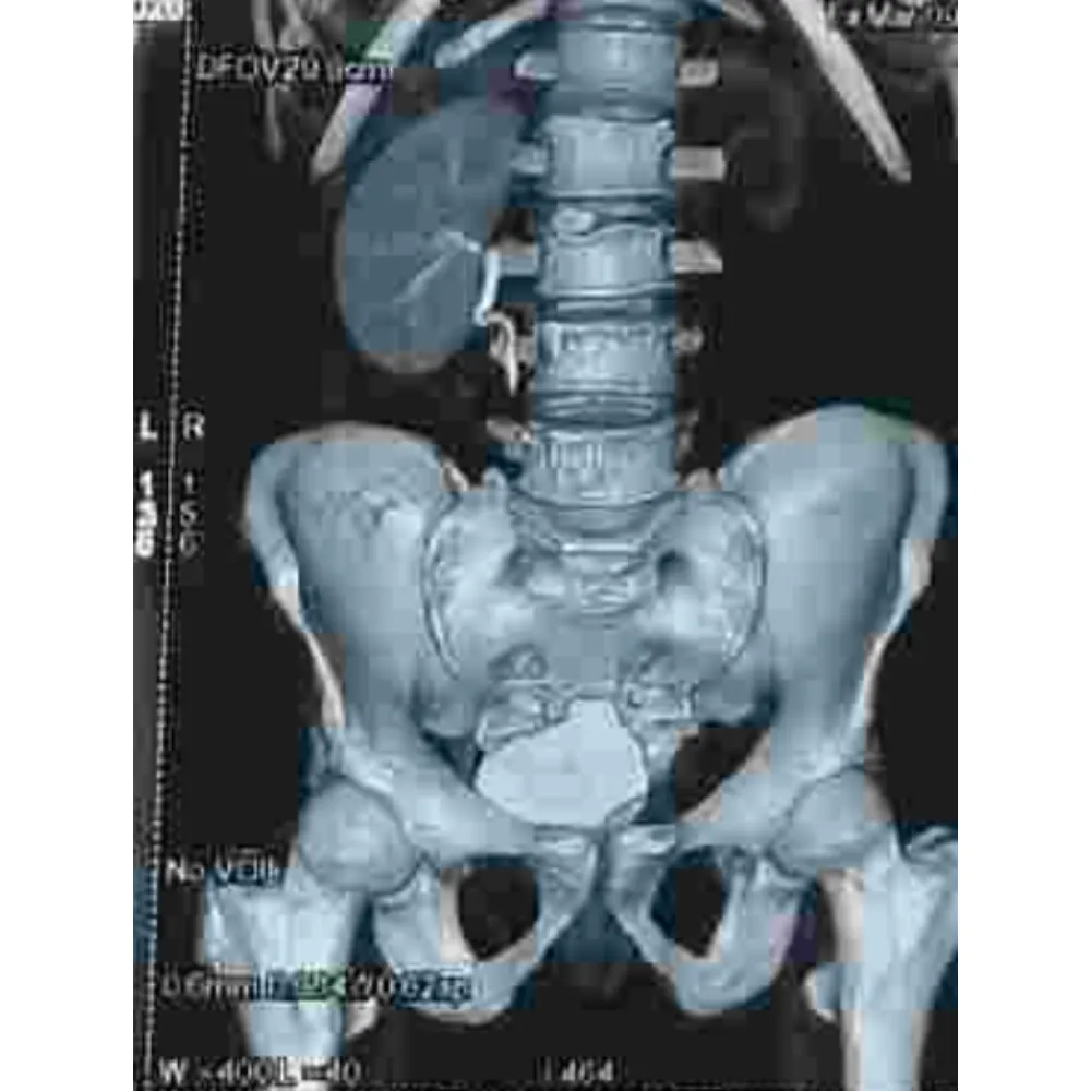 Advanced Endoscopic Transurethral Resection and Biopsy for Complex Bladder Mass 1