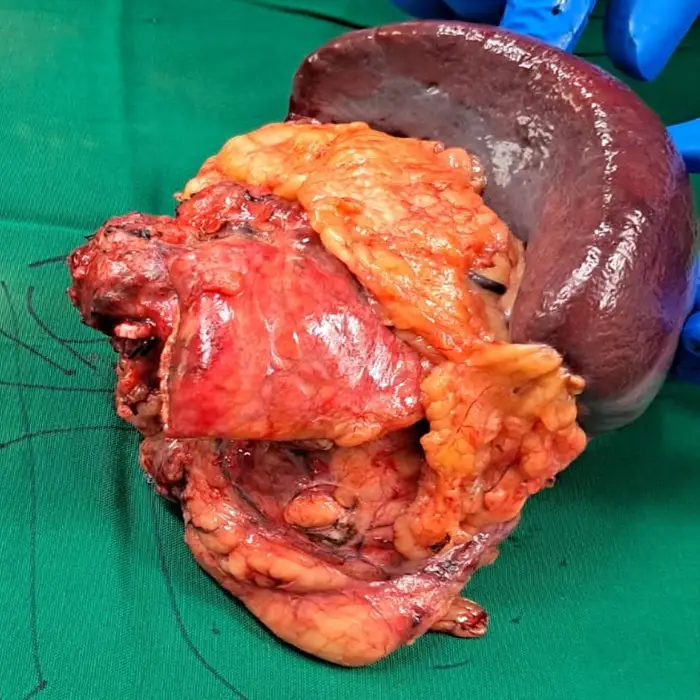 Advanced Left Radical Nephrectomy With Distal Pancreatosplenectomy For Recurrent Adrenocortical Carcinoma 4