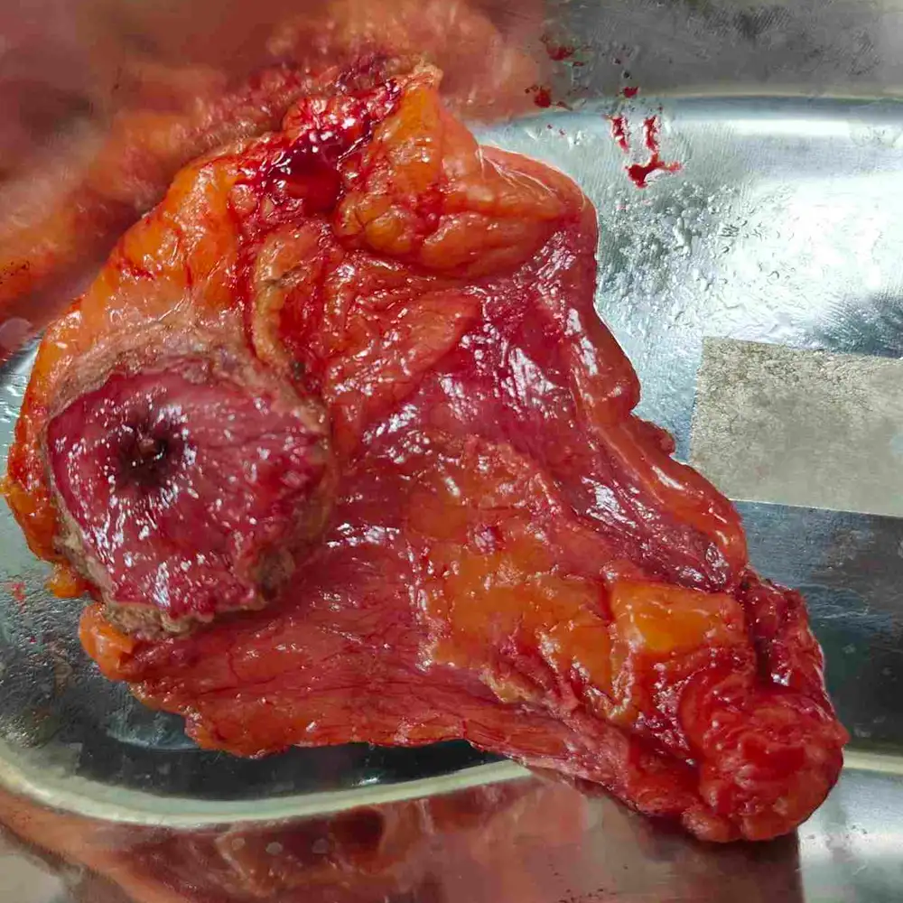 Advanced Partial Cystectomy And Retroperitoneal Lymph Node Dissection For Urachal Carcinoma 1