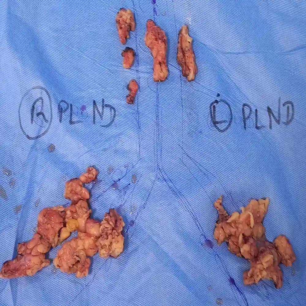 Advanced Radical Cystectomy And Lymph Node Dissection For High Grade Bladder Cancer 1