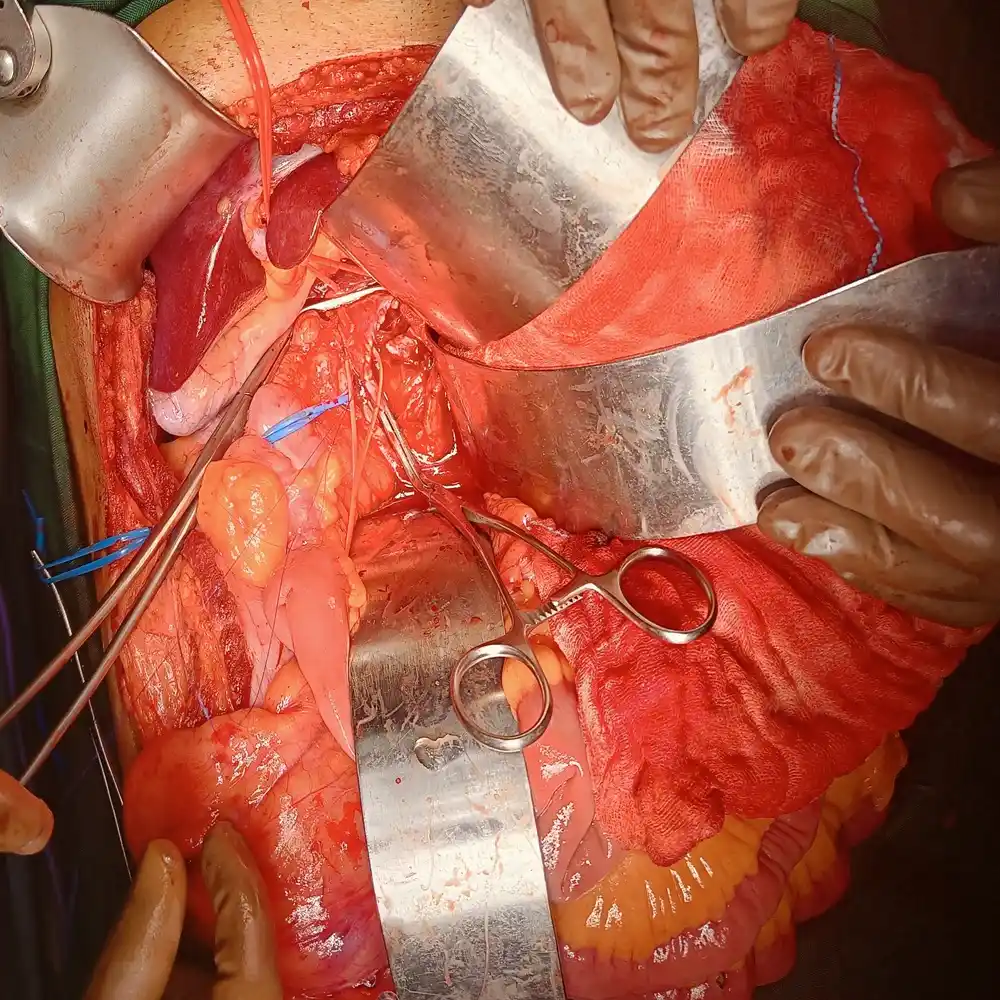 Advanced Radical Nephrectomy and IVC Thrombus Resection for Complex Renal Cell Carcinoma 4