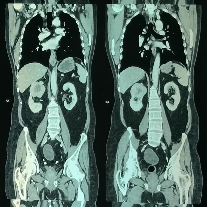 Advanced Right Radical Nephrectomy For Large Renal Cell Carcinoma With Bony Metastases 4