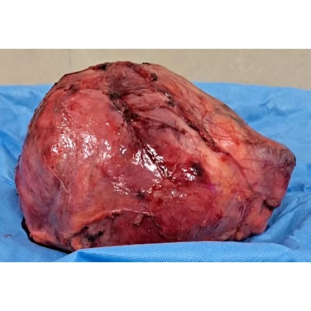 Advanced Right Radical Nephrectomy For Massive High Grade Renal Cell Carcinoma With IVC Compression 4
