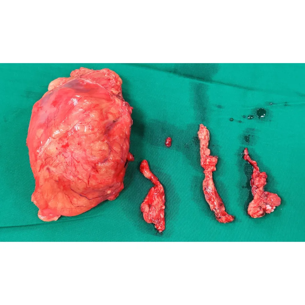 Complex Radical Nephrectomy and IVC Thrombus Resection for Advanced Renal Cell Carcinoma 4