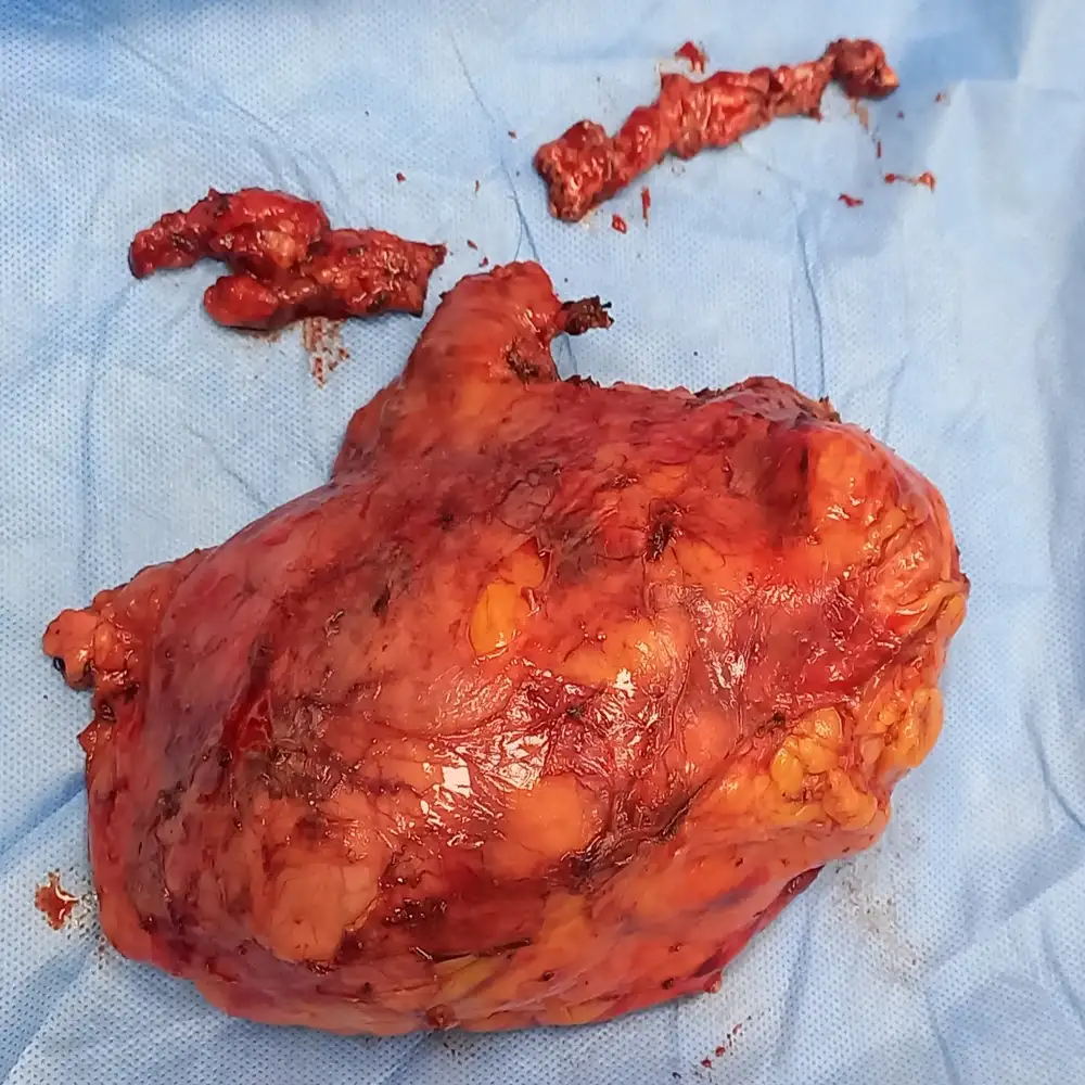 Complex Radical Nephrectomy for Renal Cell Carcinoma with Level II IVC Tumor Thrombus 4