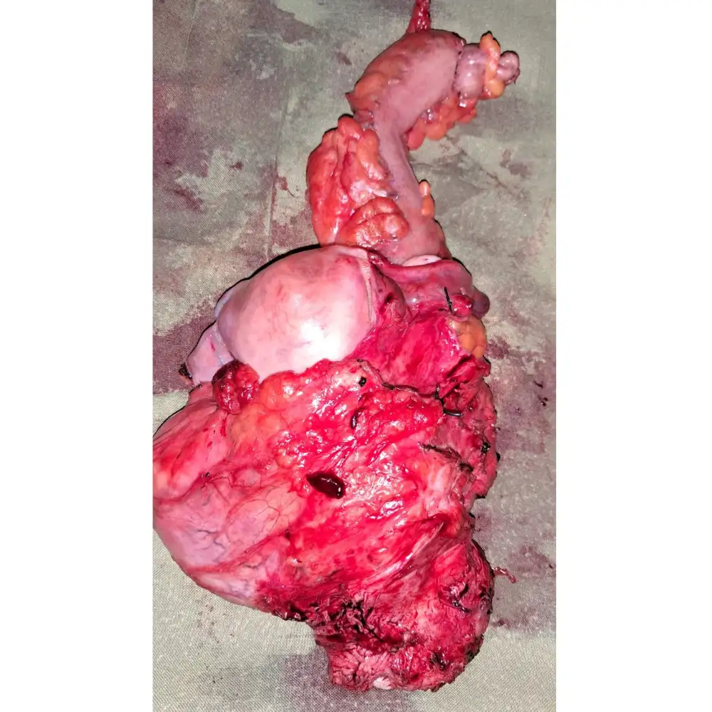 Complex Total Pelvic Exenteration For Recurrent Cervical Cancer Following Chemoradiation 1