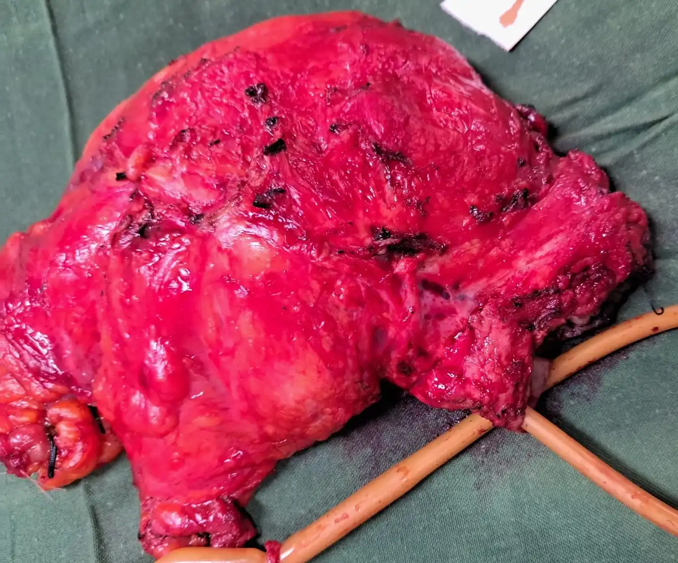 Complex Total Pelvic Exenteration for Stage IV Advanced Cervical Cancer 1