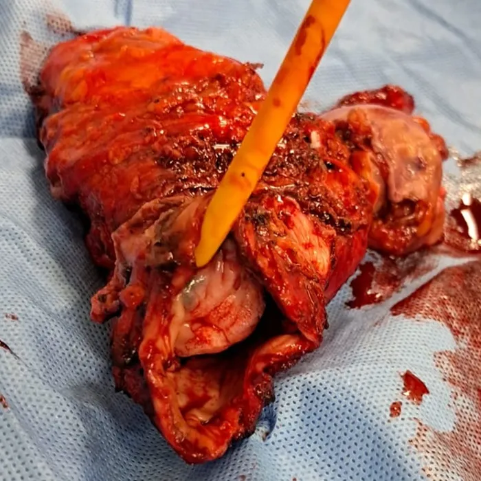 Complex Total Pelvic Exenteration with Ileal Conduit for Recurrent Sigmoid Colon Cancer 1