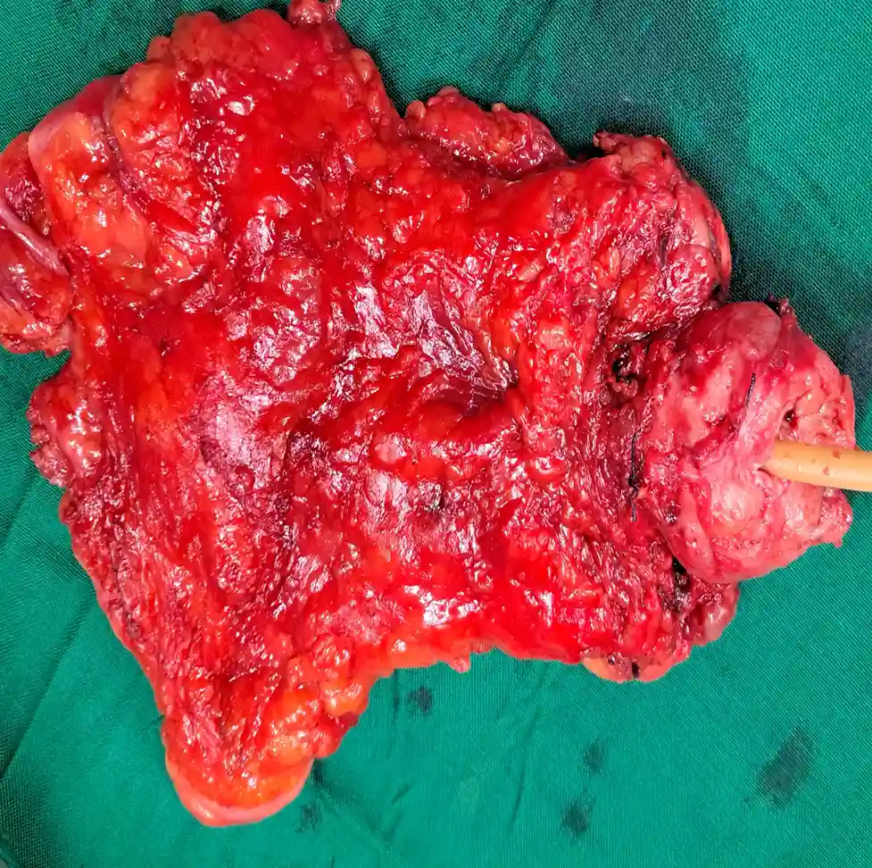 Laparoscopic Radical Cystoprostatectomy And Neobladder Reconstruction For Invasive Bladder Cancer 1