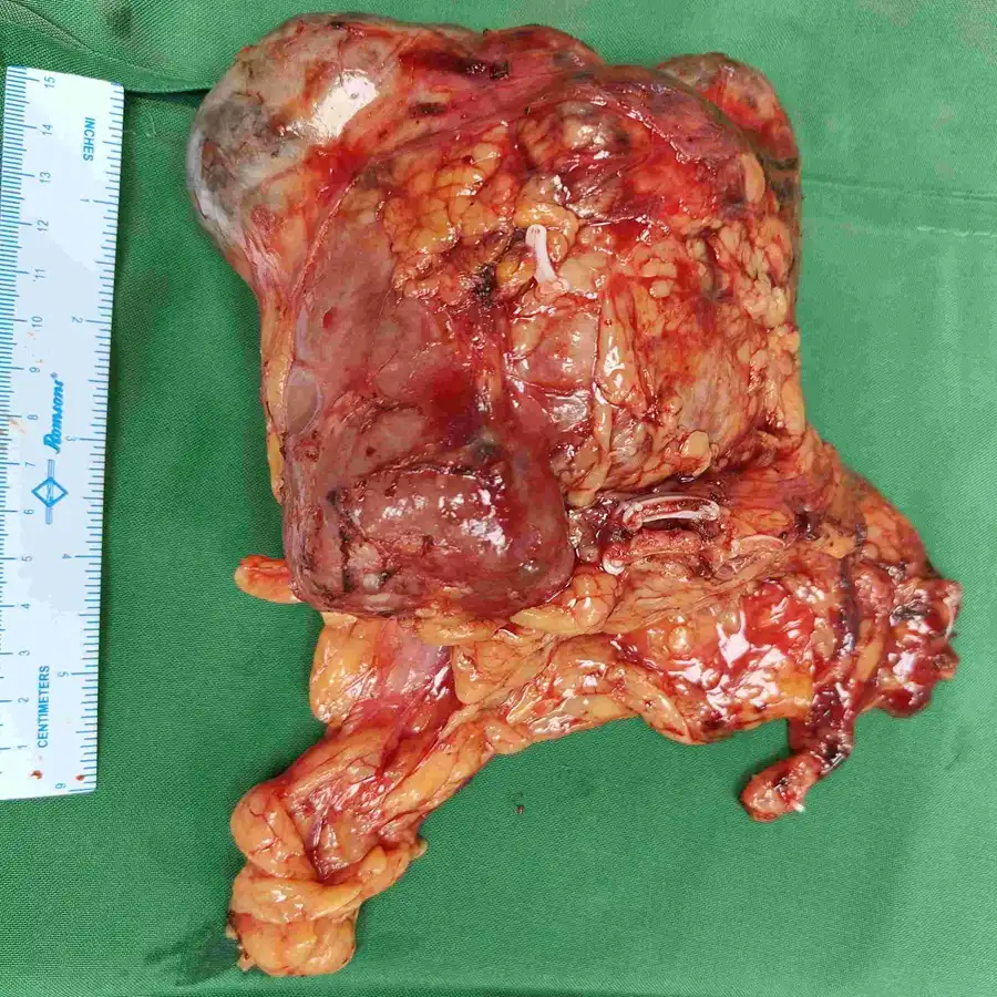 Laparoscopic Radical Nephrectomy and Lymph Node Dissection for High Complexity Renal Cell Carcinoma 4