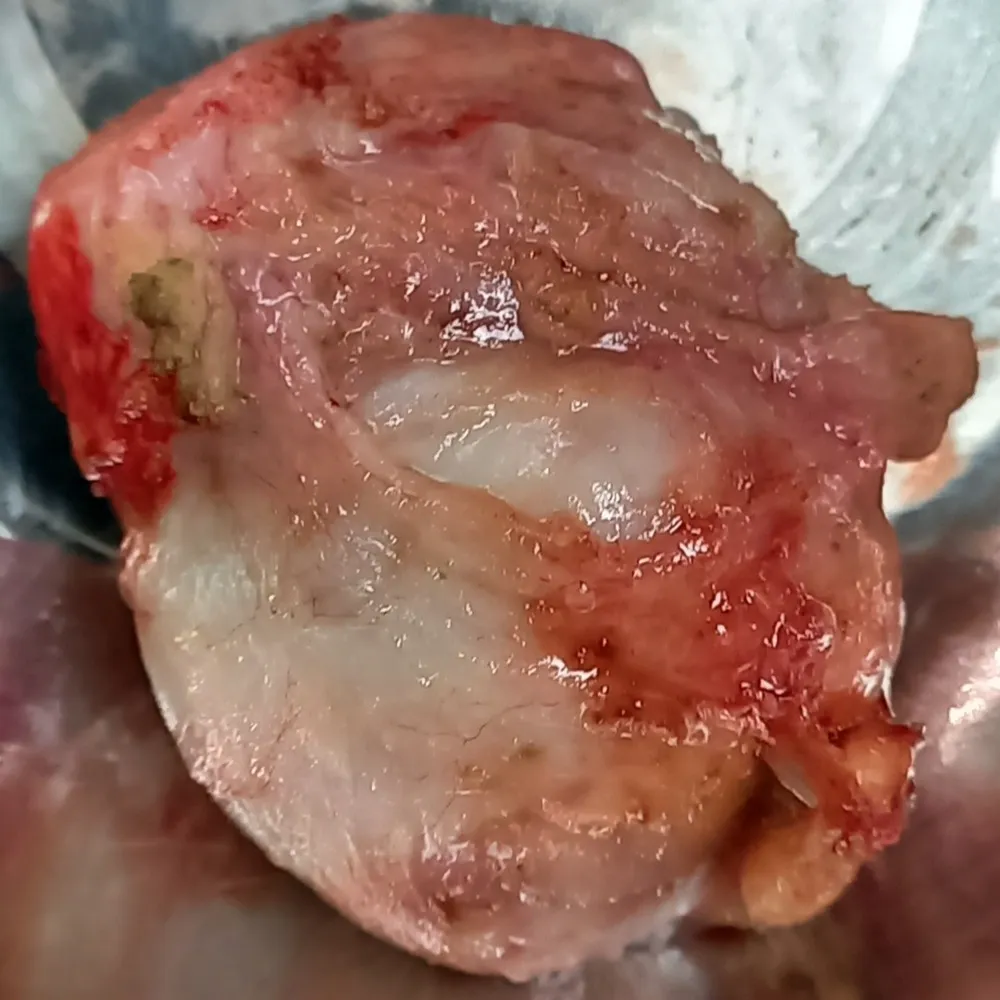 Palliative Surgery for Metastatic Prostate Cancer Gleason 9 with Urinary Relief and Early Recovery – Real Case 4