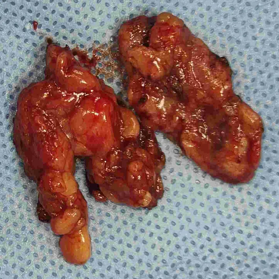 Radical Cytoreductive Nephrectomy and Lymph Node Dissection for Complex Right Renal Mass 4