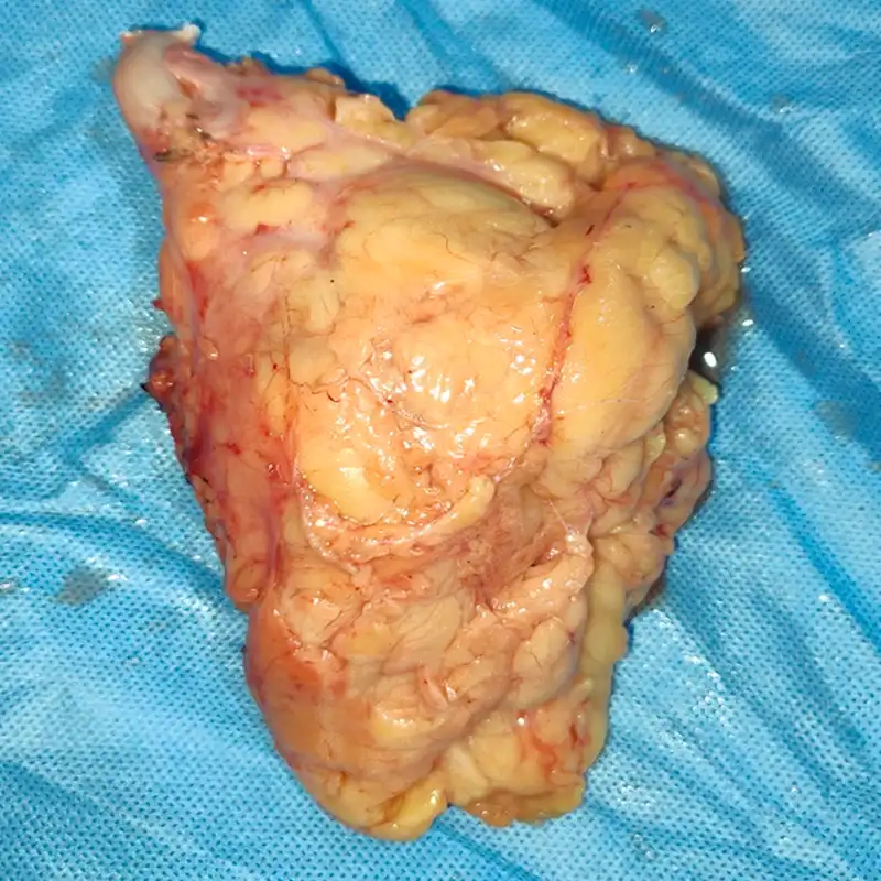 Radical Left Nephrectomy and Para Aortic Lymph Node Dissection 4