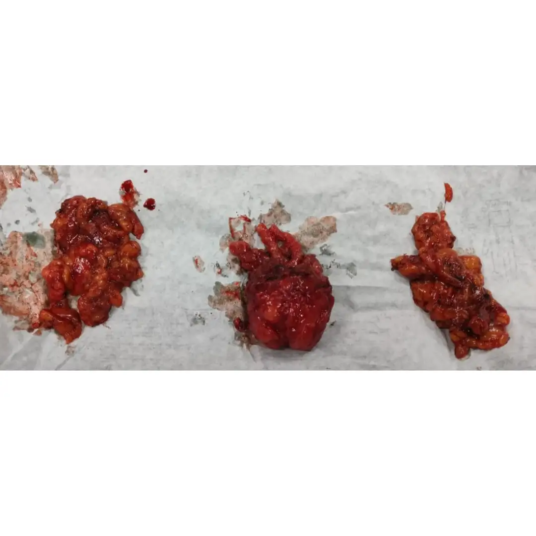 Radical Prostatectomy for Prostate Cancer with Negative Margins and Excellent Recovery – Real Patient Case 4