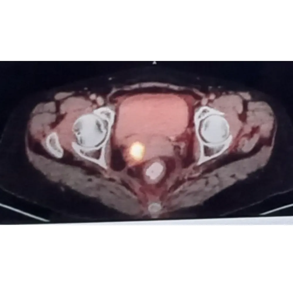 Robotic Anterior Exenteration With Ileal Conduit For Recurrent Stage IV Cervical Carcinoma 1