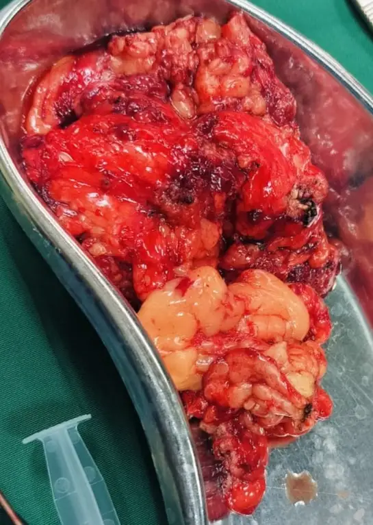 Robotic Anterior Exenteration for Post Radiation Residual Cervical Carcinoma 1