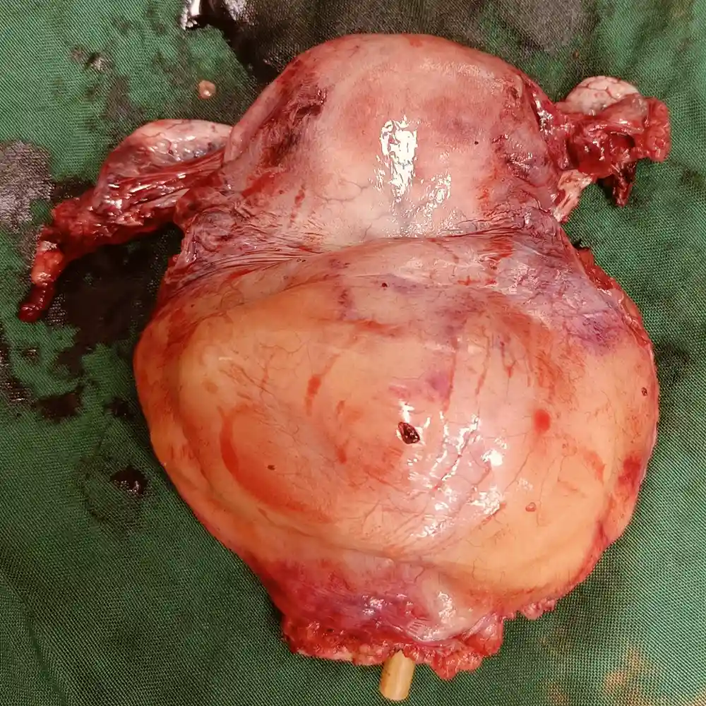 Robotic Anterior Pelvic Exenteration With Ileal Conduit For Recurrent Cervical Carcinoma 1