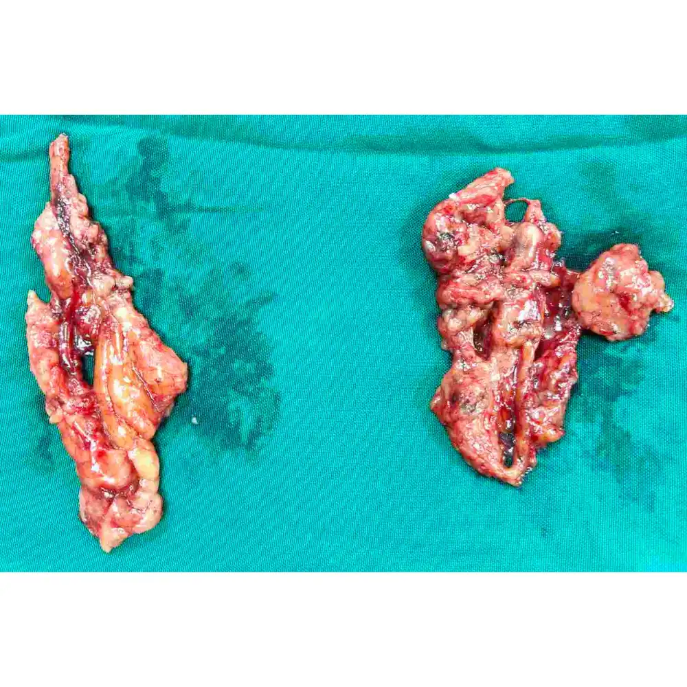 Robotic Assisted Radical Cystoprostatectomy And Ileal Conduit For Muscle Invasive Bladder Cancer 1