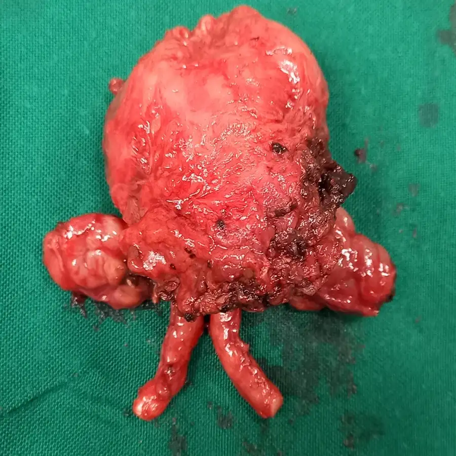 Robotic Assisted Radical Prostatectomy for Acinar Adenocarcinoma with Focal Extension 4