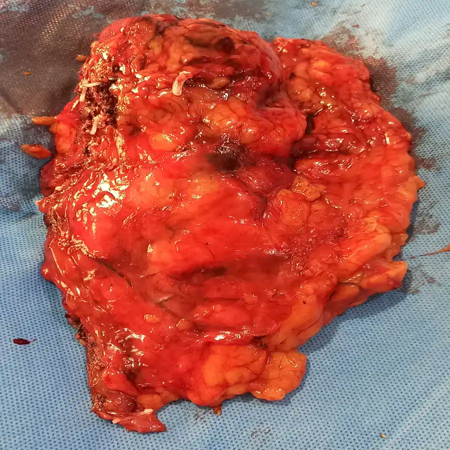 Robotic Left Extended Radical Nephrectomy for Complex Renal Cell Carcinoma 4