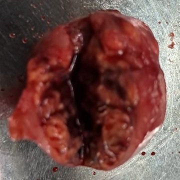 Robotic Left Partial Nephrectomy For Clear Cell Renal Carcinoma In A Young Patient 4