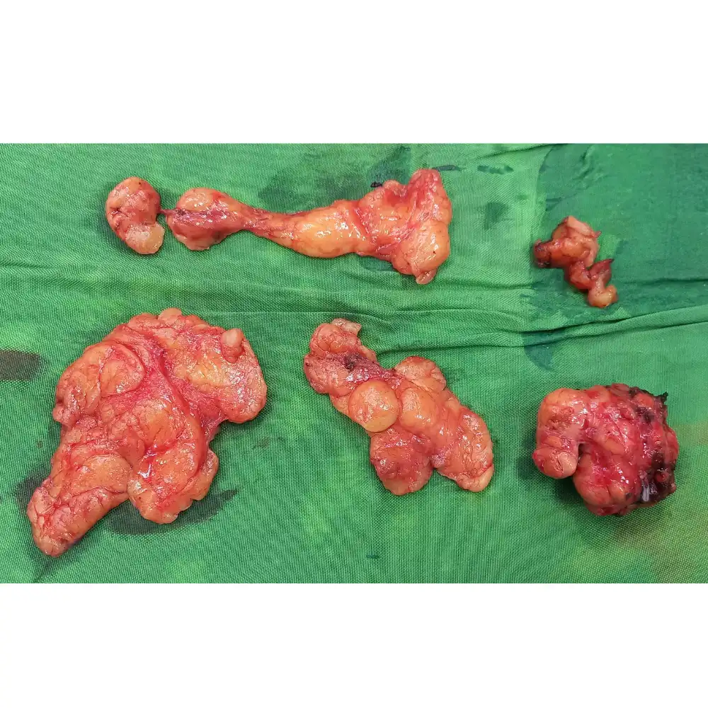 Robotic Left Partial Nephrectomy for Localized Clear Cell Renal Cell Carcinoma 4